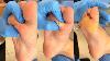 Pedicure To Treat Viral Warts Dig It Out
