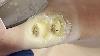 Warts That Have Been Treated Once The Recovery Effect Is Very Good Xue Yidao